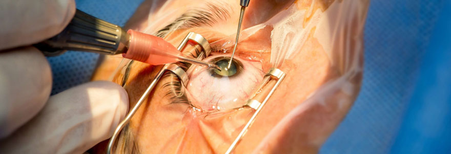 chirurugie des yeux